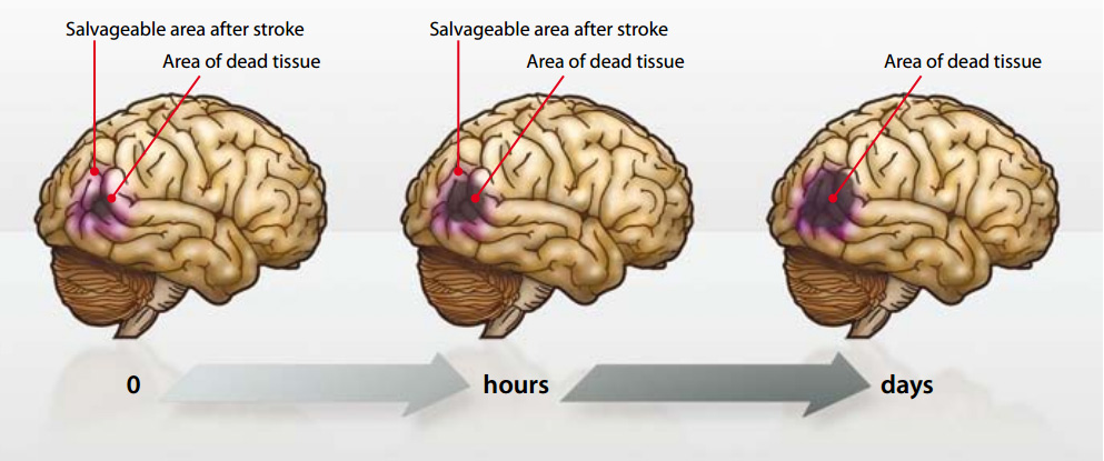 He is a brain. Brain stroke. Time is Brain.